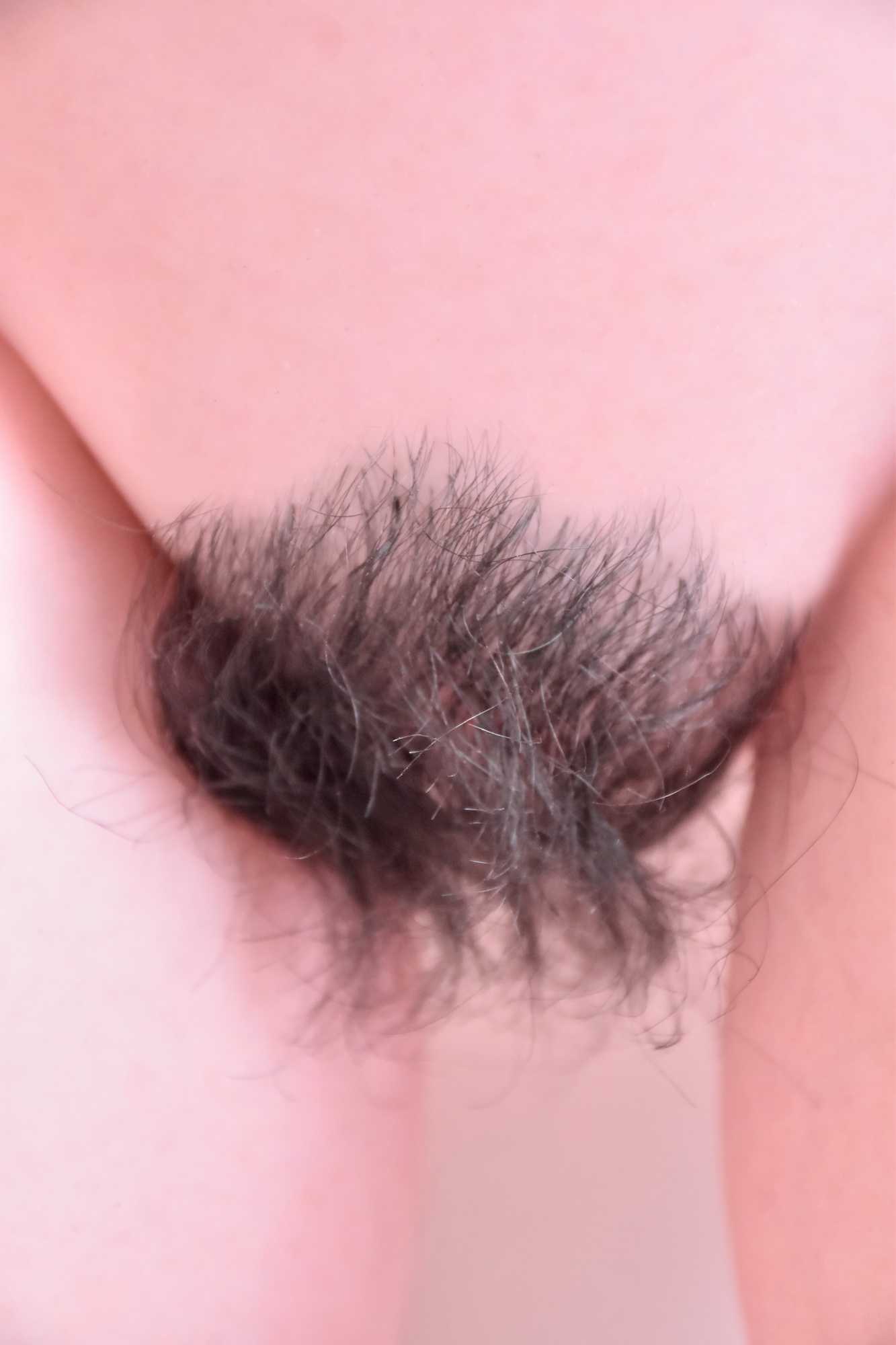 12-Hair or pubic hair implant（6）.jpg