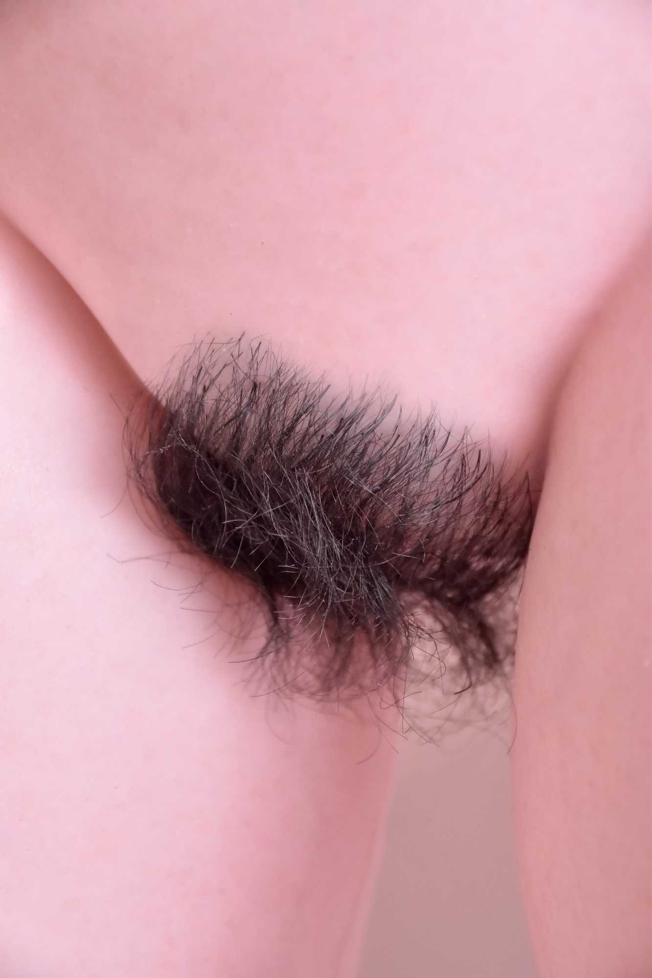 12-Hair or pubic hair implant（7）.jpg