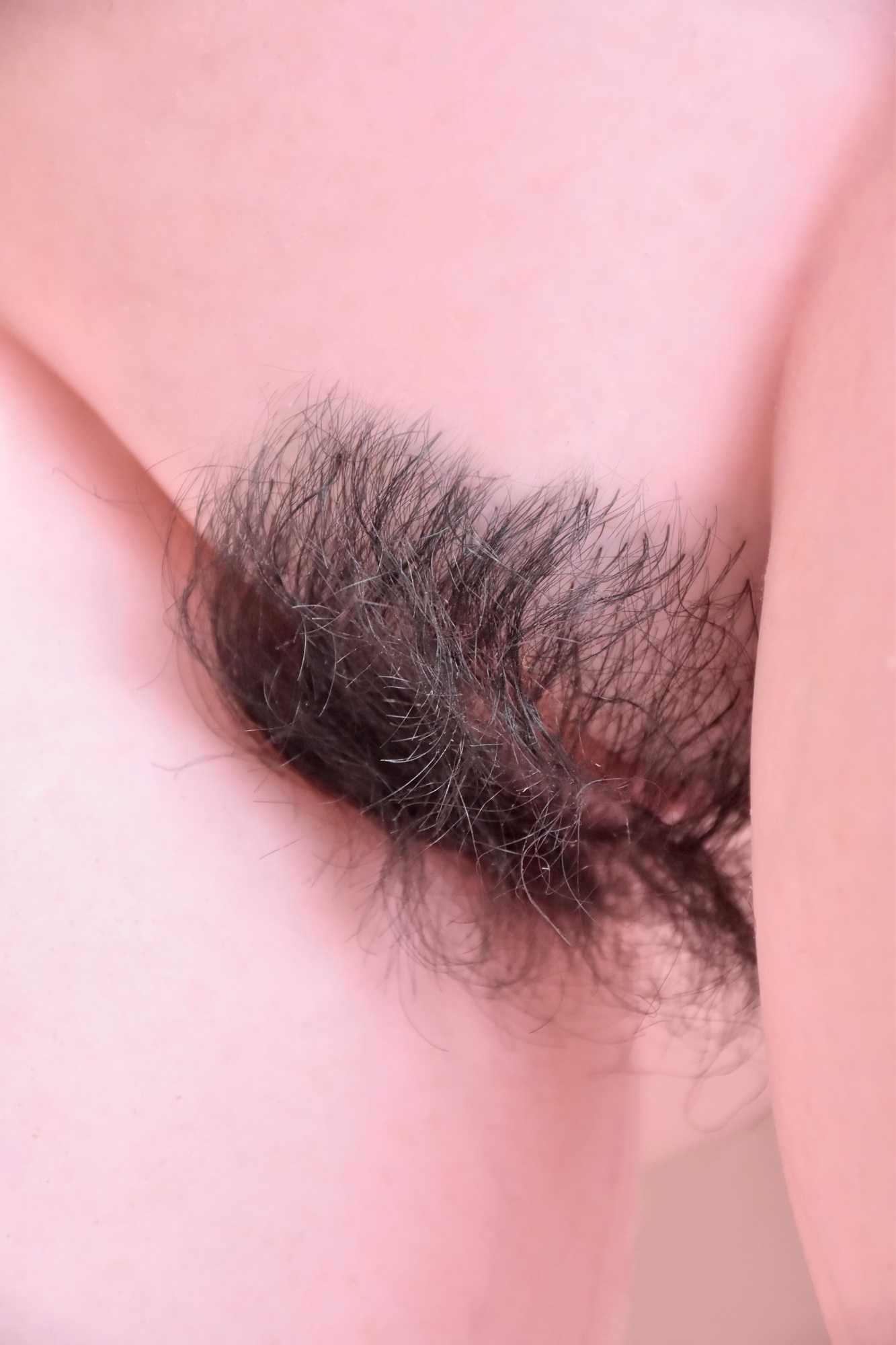 12-Hair or pubic hair implant（9）.jpg